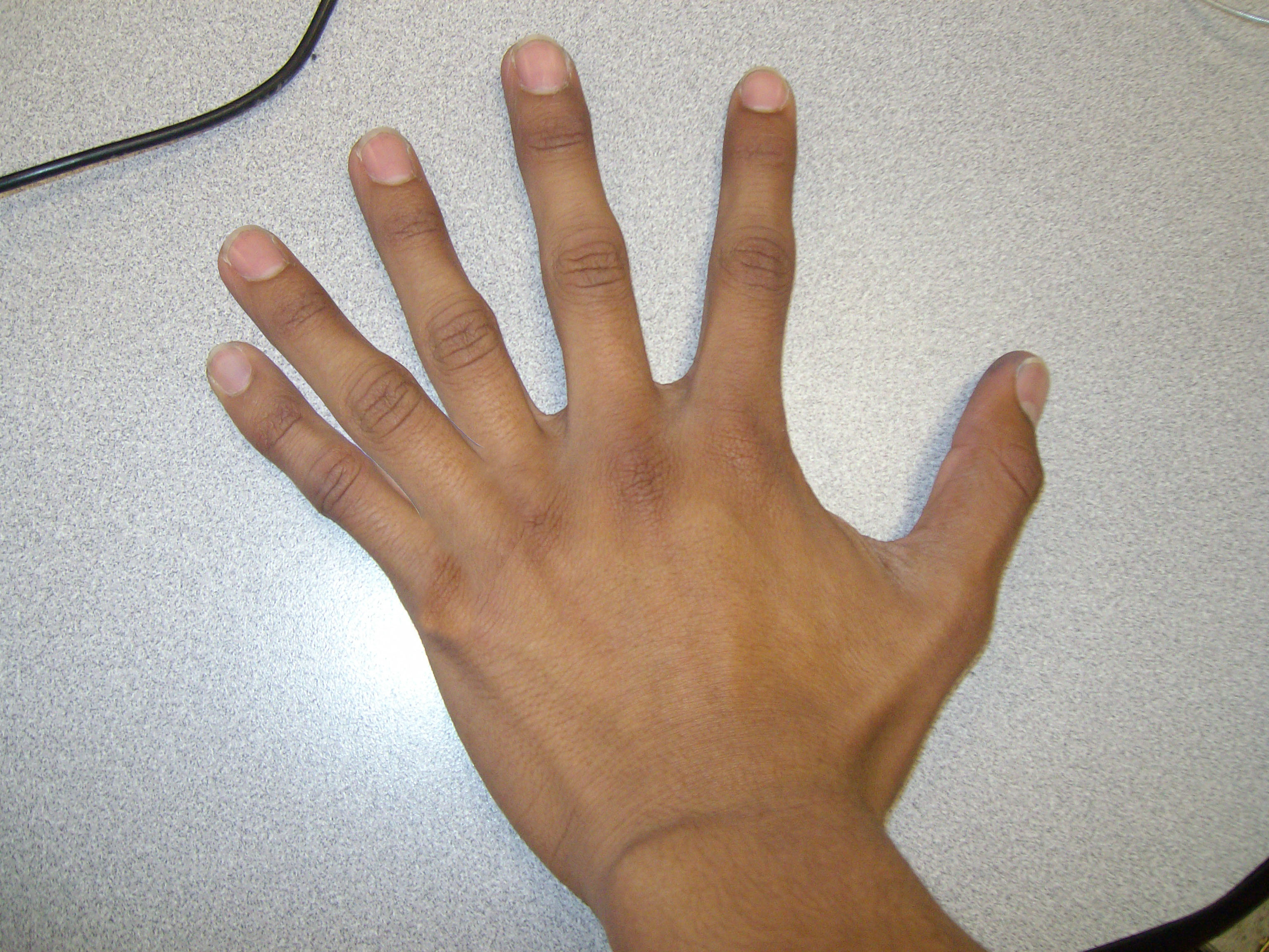 Image result for hand with 6 fingers